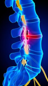cirurgia-de-coluna