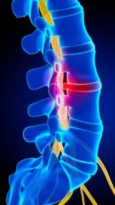 cirurgia-de-coluna